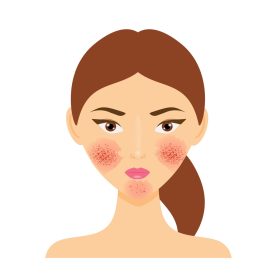 Rosacea