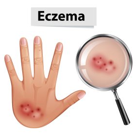Ekcéma