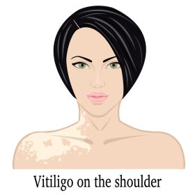 Vitiligo