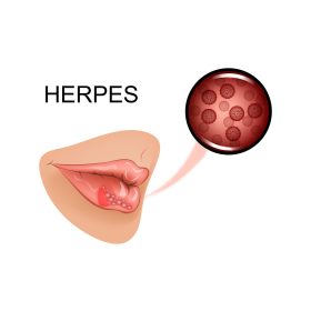 Herpesz
