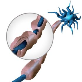 Sclerosis Multiplex