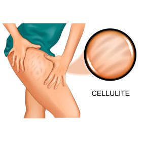 Narancsbőr (Cellulitis)